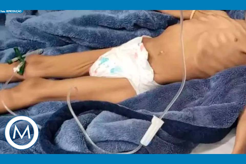 menina de 3 anos em desnutrição