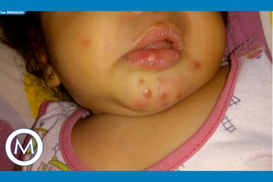 BEBÊ MORRE APÓS TOMAR DIPIRONA NA VEIA EM GOIÁS