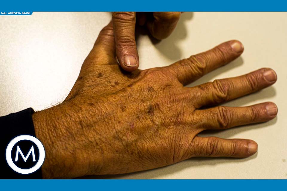 TRATAMENTO DE CÂNCER DE PELE NO SUS